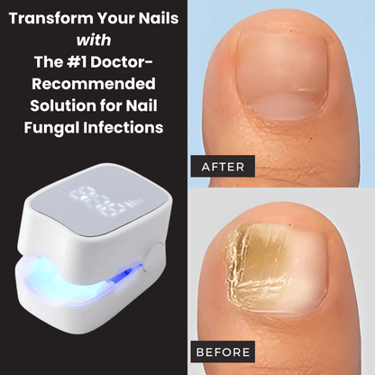 ClearNail Pro™ - Nail Fungus Laser Device