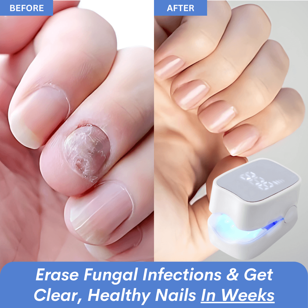 ClearNail Pro™ - Nail Fungus Laser Device