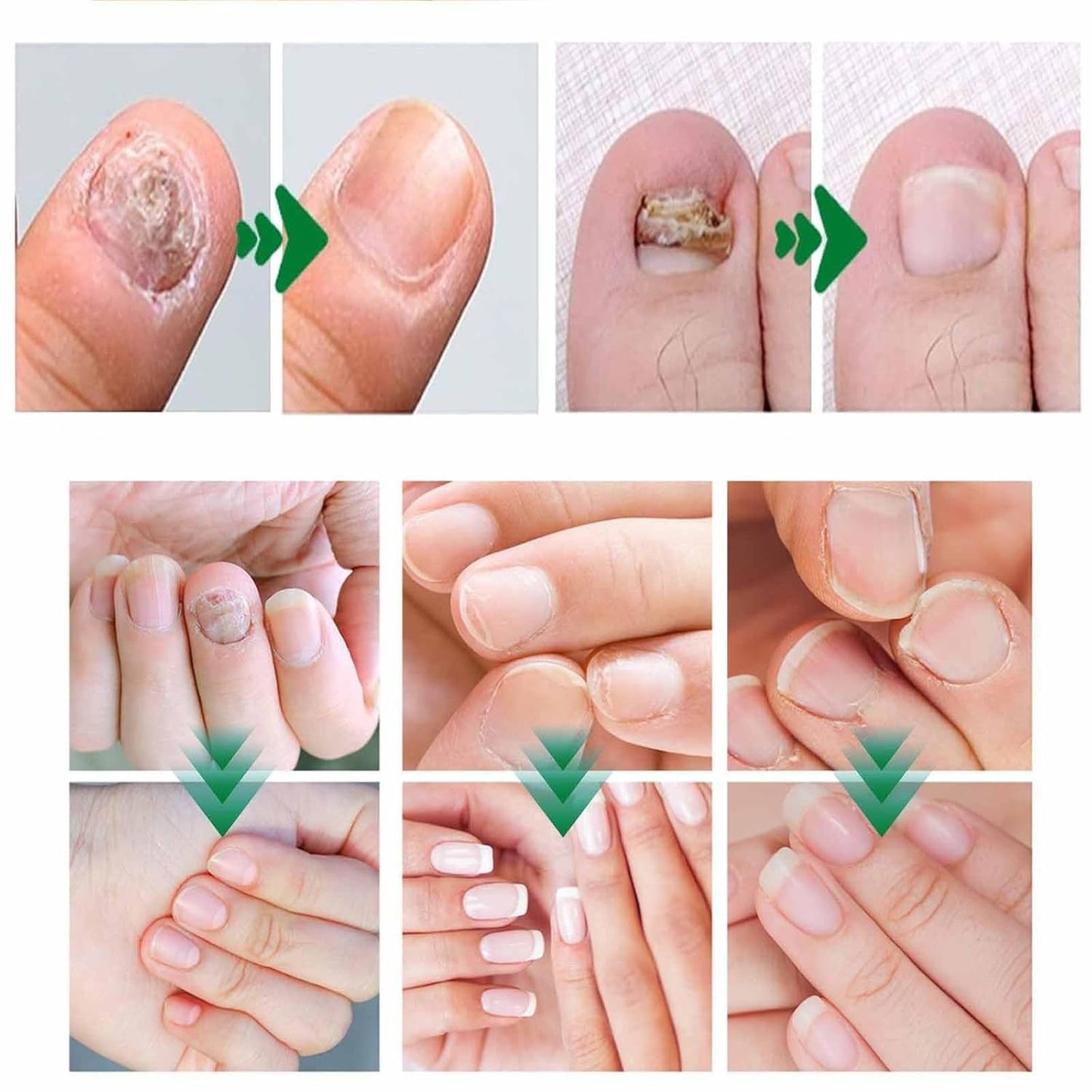 LOVILDS Natural Nail Fungus Treatment Gel - Fungus Cream, Multi-Purpose Nail Repair