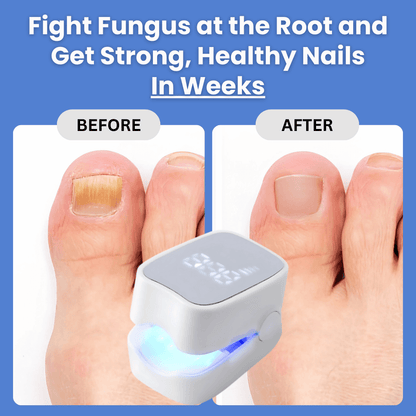ClearNail Pro™ - Nail Fungus Laser Device