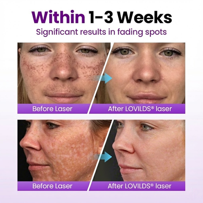 LOVILDS® SpotErase Probiotic Shield Serum