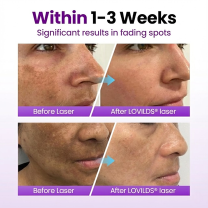 LOVILDS® SpotErase Probiotic Shield Serum